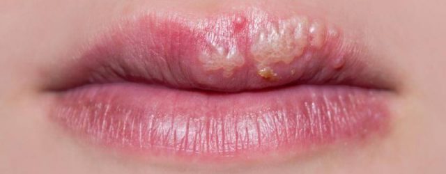 forebyg herpes