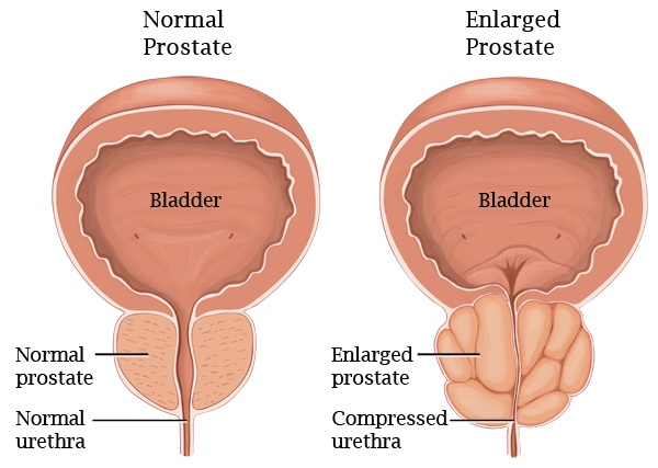 behandlinger og symptomer forstørret prostata