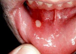 Penge gummi mikro Arthur Svamp i munden - Effektive behandlinger mod mundsvamp (Video)