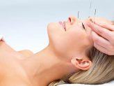 akupunktur og migræne