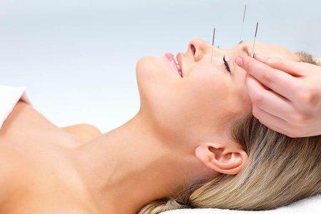 akupunktur og migræne