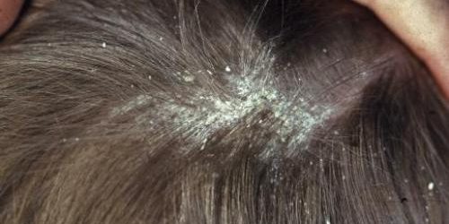 Pityriasis capitis