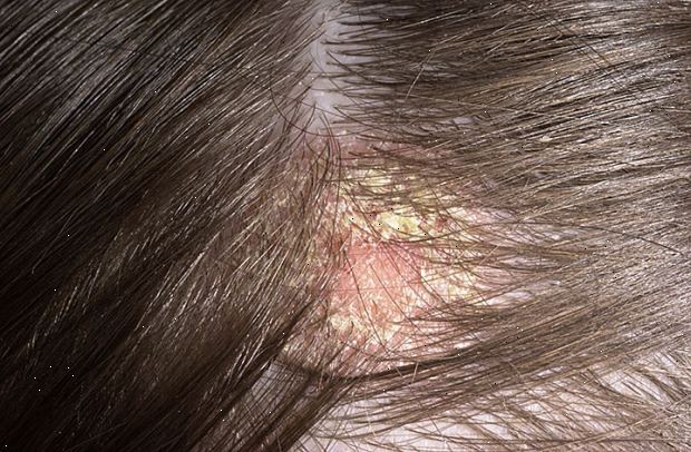Eksem i hovedbunden - Risikerer hårtab og virker shampooer?