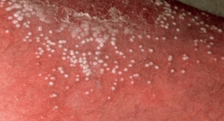 PUSTULØS PSORIASIS