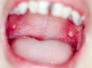 I tandkødet kræft 7 årsager