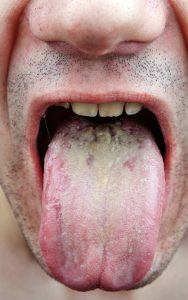 Kræft på tungen
