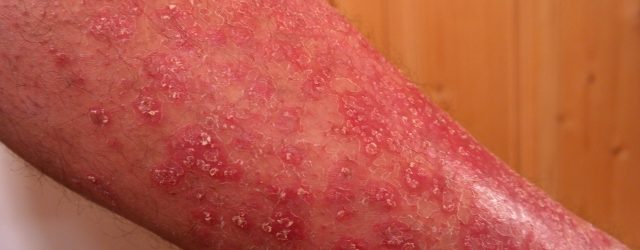 psoriasisbehandling