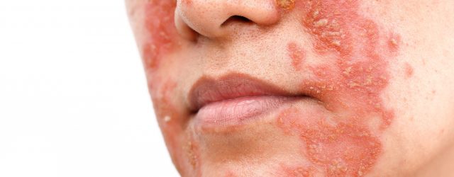 psoriasis ansigt