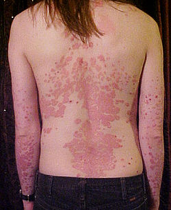 psoriasis billede på ryggen
