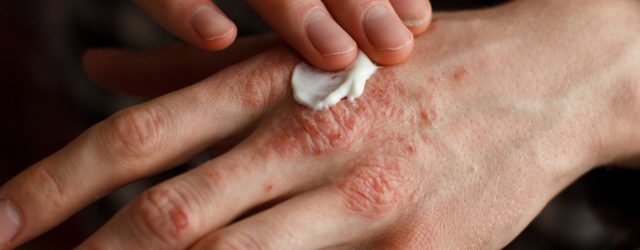 psoriasis lotion