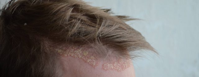 psoriasis i hovedbunden