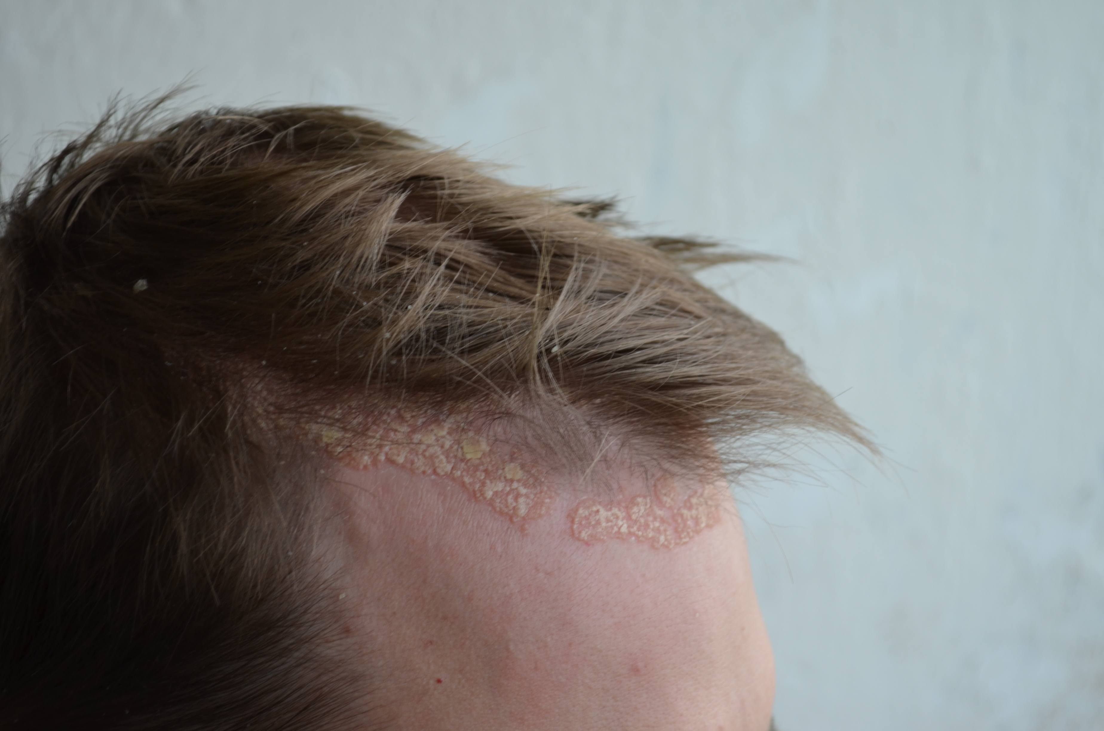 Psoriasis Symptomer Bilder Symptomer 2020 Psoriasis Symptomer Bilder Symptomer 2020