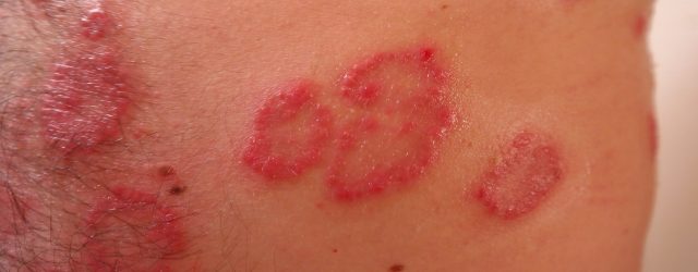 Psoriasis guttat