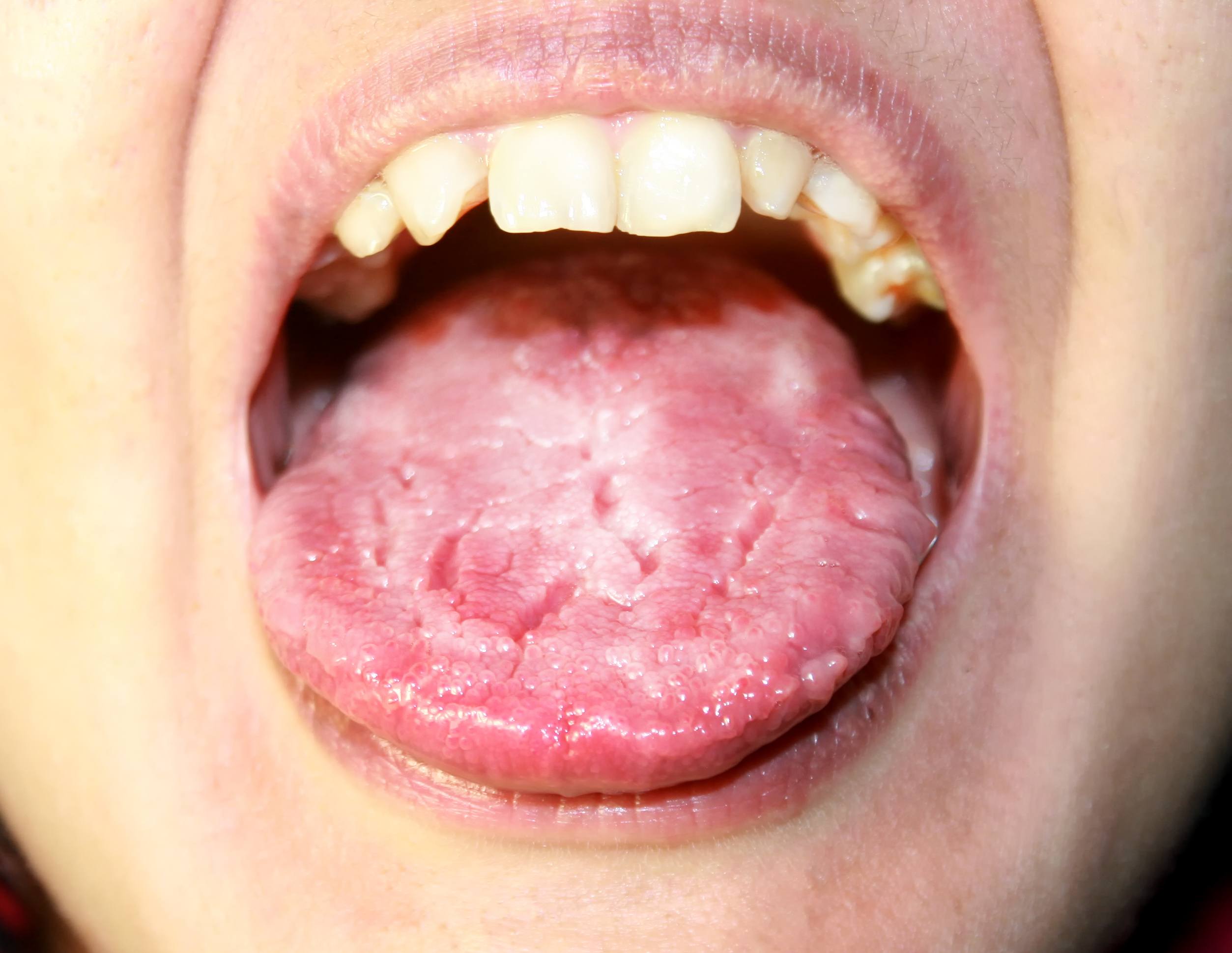 I munden symptomer kræft Flere får