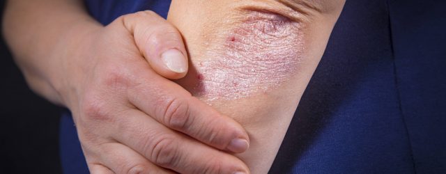 psoriasis udseende
