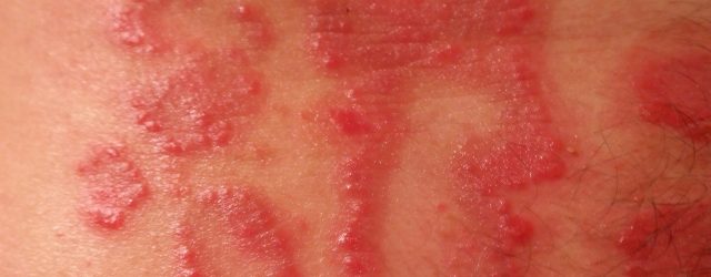 udslæt psoriasis